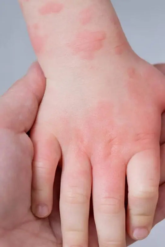 Understanding Topical Steroid Withdrawal Syndrome (TSWS): Causes, Symptoms, and Solutions - Organic Cosmetics Company